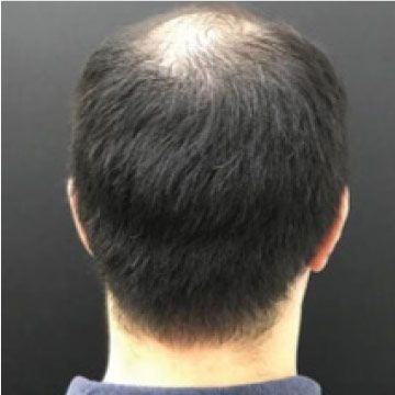 EW Villa Medica - Hair Follicles Regenerator (HFR), Hair loss treatment with HFR / Duration: 6 weeks